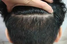 植發(fā)項目示例圖